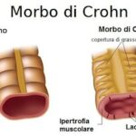 morbo-di-Crohn-500×325