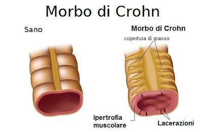 morbo-di-Crohn-500×325