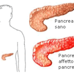 pancreatite_0