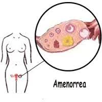 Amenorrea: che che cos'è e quali sono le cause