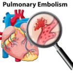 embolia-polmonare-di-anutomia-umana_1308-17582