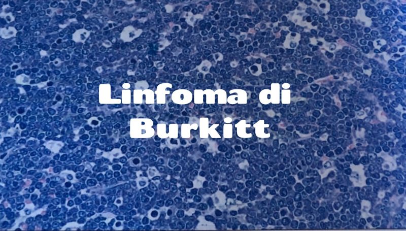 il Linfoma di Burkitt [ il primo tumore umano associato ad un virus