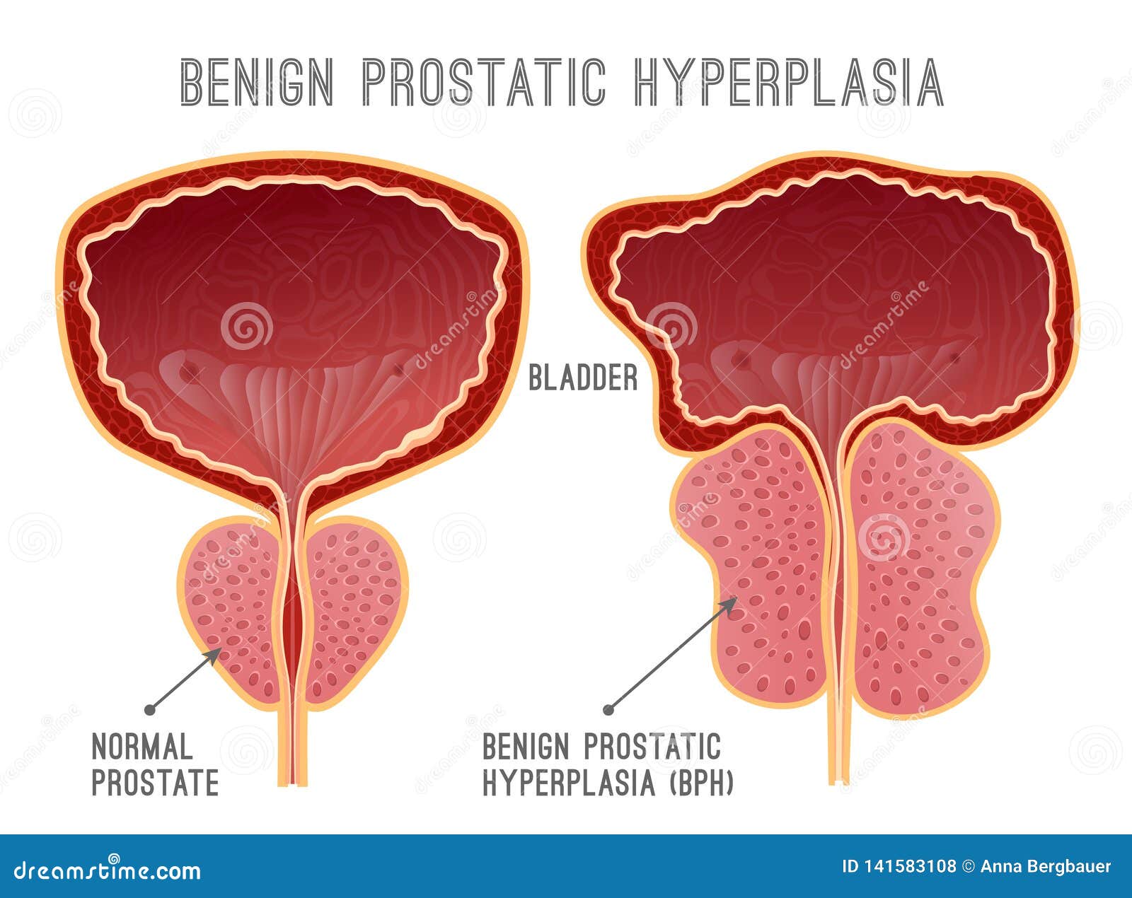 prostate-disease-infographic-benign-prostatic-hyperplasia-prostate-disease-infographic-urology-medical-image-urinary-bladder-141583108