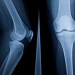 X-Ray of human knee