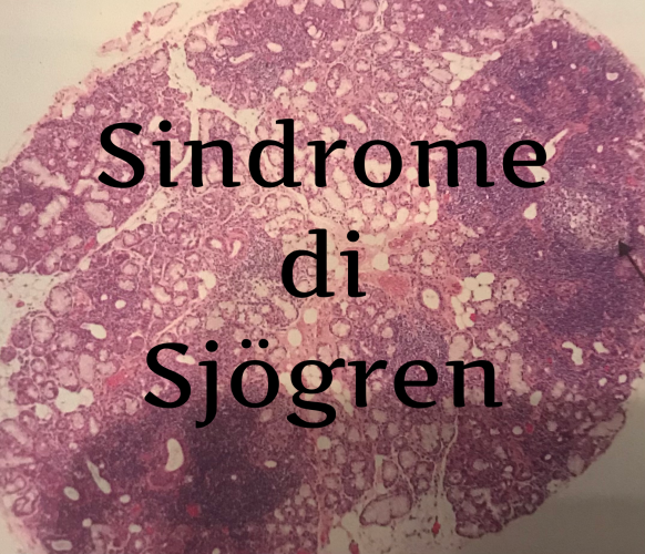 La Sindrome di Sjögren è una malattia autoimmune. La Sindrome di Sjögren si manifesta con secchezza della bocca e degli occhi. La Sindrome di Sjögren colpisce principalmente persone affete da altre malattie autoimmini. 
