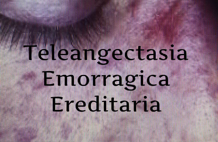 La teleangectasia emorragica ereditaria è causata da diverse mutazioni di due geni. La teleangectasia emorragica ereditaria è una malattia rara che causa aumentata frgilità capillare. La teleangectasia emorragica ereditaria si manifesta co lesioni cutanne, chiazze sul volto ecc..