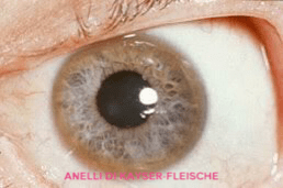 Gli anelli di Kayser-Fleischer sono degli anelli di color giallo-brunastro. Gli anelli di Kayser-Fleischer Sono costituiti da depositi di rame. La presenza degli anelli di Kayser-Fleischer è un segno diagnostico della malattia di Wilson.