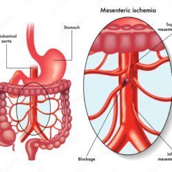 Infarto intestinale