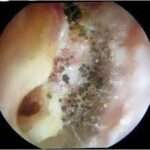 La micosi del condotto uditivo esterno, o otomicosi, è un'infezione del condotto uditivo esterno causata da funghi. I funghi che causano più comunemente la micosi del condotto uditivo esterno sono Aspergillus niger e Candida albicans.