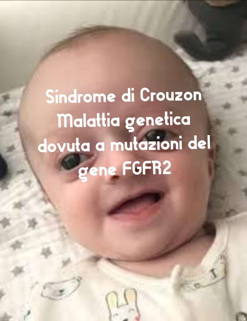 La sindrome di Crouzon è una malattia genetica dovuta a mutazioni nel gene FGFR2.La sindrome di Crouzon è caratterizzata da craniosinostosi e da un'innaturale sviluppo di alcuni elementi facciali. La sindrome di Crouzon provoca disfunzioni che possono riguardare la vista, l’udito, l’assunzione di cibo. La sindrome di Crouzon è causata dalla mutazione di uno di due geni che si trovano sul cromosoma 4 e sul cromosoma 10.