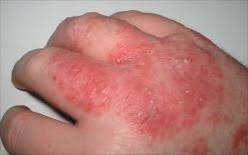 La dermatite allergica da contatto è una comune affezione cutanea caratterizzata dalla presenza di lesioni eritemato maculo- vescicolo- crostose e da prurito, causati dal contatto con un allergene.
