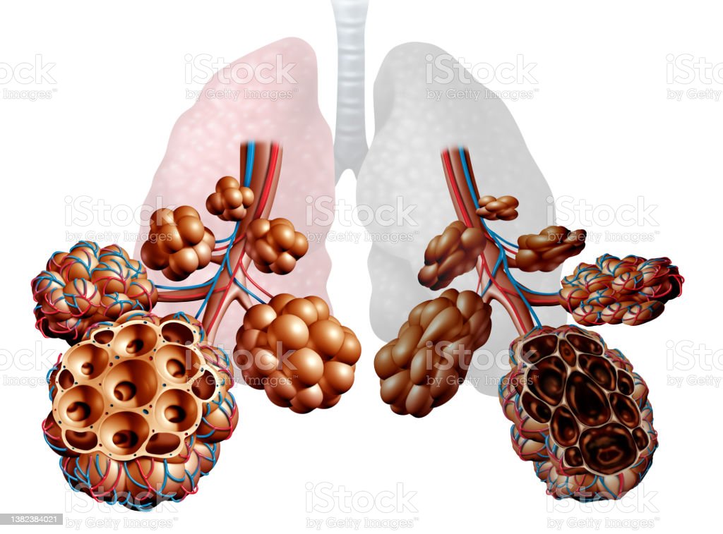 enfisema 2