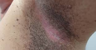 L'acanthosis nigricans è una dermatosi. Una dermatosi è una malattia della pelle. L'acanthosis nigricans è caratterizzata da un ispessimento e un inscurimento della pelle, specialmente nelle pieghe del corpo