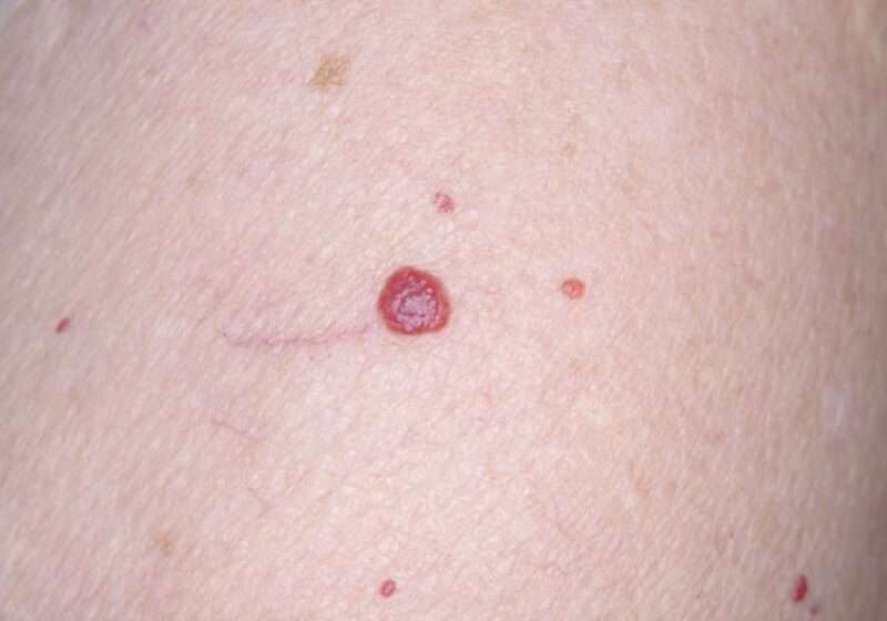 L'angioma rubino è un tumore benigno della pelle che si presenta come una piccola chiazza o papula di colore rosso vivo. È causato da un'anomalia dei vasi sanguigni, che si dilatano e si riempiono di sangue.