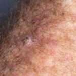 Il carcinoma squamocellulare (CSC) della pelle è un tipo di cancro che si sviluppa dalle cellule squamose presenti nello strato esterno della pelle, chiamato epidermide.