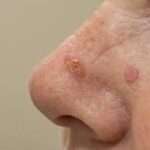 La cheratosi è una condizione della pelle caratterizzata da un ispessimento dello strato corneo, il più esterno dell'epidermide.