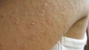 La cheratosi pilare è una condizione della pelle che si manifesta con la comparsa di piccole protuberanze simili a foruncoli, di colore rosso o rosa, sulla pelle.