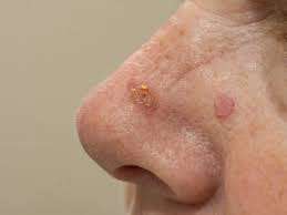 La cheratosi è una condizione della pelle caratterizzata da un ispessimento dello strato corneo, il più esterno dell'epidermide.