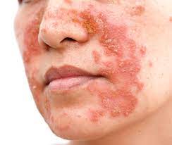 La dermatite del viso è una condizione infiammatoria della pelle che può colpire qualsiasi area del viso. È una condizione comune che può interessare persone di tutte le età, ma è più comune nei bambini e negli adulti giovani.