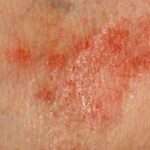 L'eczema è una malattia della pelle caratterizzata da un'infiammazione che provoca prurito, arrossamento, gonfiore e spesso la comparsa di eruzioni cutanee. È una condizione cronica e ricorrente che può manifestarsi in diversi modi, come la dermatite atopica, il dermatite da contatto, la dermatite seborroica e l'eczema nummulare.