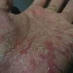 L'eczema disidrosico è una condizione cronica della pelle che causa la formazione di piccole bolle pruriginose sulle mani e sui piedi. Le bolle possono essere piene di liquido o di pus e possono rompersi, lasciando delle croste.