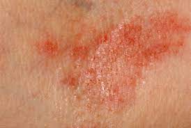L'eczema è una malattia della pelle caratterizzata da un'infiammazione che provoca prurito, arrossamento, gonfiore e spesso la comparsa di eruzioni cutanee. È una condizione cronica e ricorrente che può manifestarsi in diversi modi, come la dermatite atopica, il dermatite da contatto, la dermatite seborroica e l'eczema nummulare.
