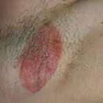 L'eritrasma è un'infezione batterica cronica della pelle che colpisce le pieghe cutanee, come l'inguine, le ascelle e le pieghe sottomammarie. L'eritrasma si manifesta tipicamente come macchie di colore rosa o marrone, di solito di dimensioni comprese tra 1 e 5 cm.