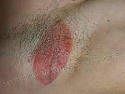 L'eritrasma è un'infezione batterica cronica della pelle che colpisce le pieghe cutanee, come l'inguine, le ascelle e le pieghe sottomammarie. L'eritrasma si manifesta tipicamente come macchie di colore rosa o marrone, di solito di dimensioni comprese tra 1 e 5 cm.
