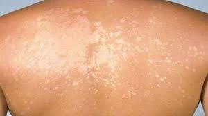 I funghi della pelle sono un gruppo di microrganismi in grado di provocare diverse malattie a carico dell'epidermide e del derma, genericamente note come micosi cutanee (o dermatomicosi).