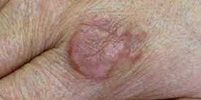  Il granuloma anulare è una malattia della pelle di natura infiammatoria. L'infiammazione è una risposta del sistema immunitario a un'infezione, un danno o un'altra condizione che causa irritazione.