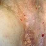 L'idrosadenite suppurativa, nota anche come acne inversa o malattia di Verneuil, è una malattia infiammatoria cronica che colpisce le ghiandole sudoripare apocrine. Si manifesta con la formazione di noduli dolorosi e infiammati, spesso contenenti pus, che possono rompersi e formare fistole e cicatrici.