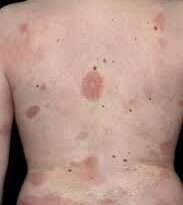 Il linfoma cutaneo, noto anche come linfoma della pelle  è un tipo di cancro che coinvolge le cellule del sistema linfatico presenti nella pelle.