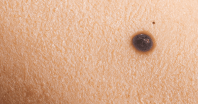 Un neo melanocitico, è una lesione pigmentata che si sviluppa sulla pelle a causa di una crescita eccessiva di cellule chiamate melanociti. I