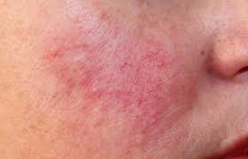 La rosacea è una condizione cronica della pelle che causa arrossamento e infiammazione del viso. È caratterizzata da episodi ricorrenti di rossore sulla zona centrale del viso, come guance, naso, mento e fronte.