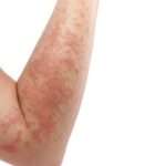 La dermatite erpetiforme (DE) è una rara malattia autoimmune che colpisce la pelle e l'intestino tenue. È caratterizzata da un'eruzione cutanea pruriginosa e vescicolare, spesso accompagnata da sintomi gastrointestinali come diarrea, dolore addominale e gonfiore.