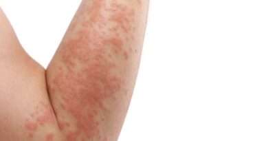 La dermatite erpetiforme (DE) è una rara malattia autoimmune che colpisce la pelle e l'intestino tenue. È caratterizzata da un'eruzione cutanea pruriginosa e vescicolare, spesso accompagnata da sintomi gastrointestinali come diarrea, dolore addominale e gonfiore.
