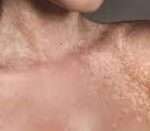 La pitiriasi versicolor è un'infezione fungina comune della pelle. È causata da un lievito che vive normalmente sulla pelle, ma che a volte può crescere troppo