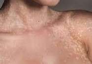 La pitiriasi versicolor è un'infezione fungina comune della pelle. È causata da un lievito che vive normalmente sulla pelle, ma che a volte può crescere troppo