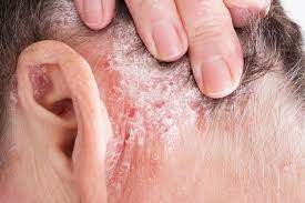 La psoriasi del cuoio capelluto è una comune forma di psoriasi che colpisce circa il 50% dei pazienti con psoriasi. È caratterizzata da chiazze rosse e squamose sul cuoio capelluto, che possono causare prurito, dolore e desquamazione.
