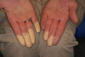 La sindrome di Raynaud è un disturbo che colpisce la circolazione sanguigna nelle dita delle mani, dei piedi e, in alcuni casi, del naso e delle orecchie. È caratterizzata da episodi di vasocostrizione, ossia restringimento dei vasi sanguigni, in risposta al freddo o allo stress emotivo.
