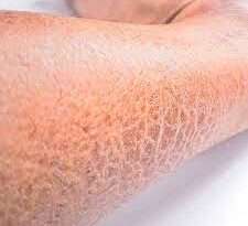 L'ittiosi volgare, anche conosciuta come ittiosi comune, è una malattia della pelle ereditaria caratterizzata da una pelle estremamente secca, squamosa e rugosa. È la forma più comune di ittiosi e può variare in gravità da lieve a grave.