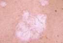 Il lichen sclerosus è una malattia cronica della pelle che colpisce principalmente le zone genitali, ma può anche manifestarsi in altre parti del corpo. Questa condizione causa la comparsa di macchie bianche e prurito intenso sulla pelle, perdita di elasticità e sottigliezza della pelle colpita, formazione di cicatrici e possibile disfunzione sessuale.