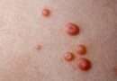 Il mollusco contagioso è un'infezione virale della pelle molto comune, soprattutto nei bambini. È causato da un virus del gruppo Poxvirus e si manifesta con piccole escrescenze rotonde e perlacee sulla pelle.