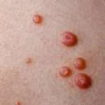 Il mollusco contagioso è un'infezione virale della pelle molto comune, soprattutto nei bambini. È causato da un virus del gruppo Poxvirus e si manifesta con piccole escrescenze rotonde e perlacee sulla pelle.