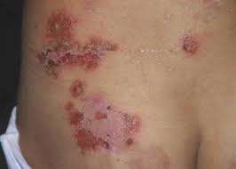 Il pemfigo è una malattia autoimmune rara e cronica che colpisce la pelle e le mucose. È caratterizzato dalla formazione di vesciche e ulcere sulla pelle e sulle membrane mucose a causa di un'attacco errato del sistema immunitario alle cellule che tengono unite le cellule della pelle.