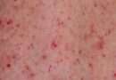 Le petecchie sono piccole macchie rosse sulla pelle causate da una rottura dei capillari. Possono essere di diverse dimensioni, da un punto a un centimetro di diametro, e sono generalmente di colore rosso vivo o viola. Le petecchie non sono dolorose e non causano prurito.
