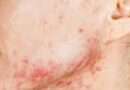 La foruncolosi è una malattia della pelle caratterizzata dalla comparsa di numerosi foruncoli, ovvero rigonfiamenti dolorosi causati da un'infezione batterica.
