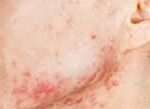 La foruncolosi è una malattia della pelle caratterizzata dalla comparsa di numerosi foruncoli, ovvero rigonfiamenti dolorosi causati da un'infezione batterica.