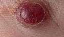 Il granuloma piogenico è un tumore vascolare benigno, che significa che si tratta di una crescita anomala dei vasi sanguigni, ma non è cancerosa. Si manifesta come un nodulo, solitamente di colore rosso vivo, che può comparire sulla pelle o sulle mucose.