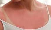 La fotosensibilità è una condizione in cui la pelle diventa eccessivamente sensibile alla luce solare o ad altre forme di luce ultravioletta (UV),